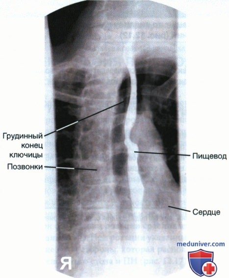 Укладка при рентгенограмме пищевода в косой ЗП проекции