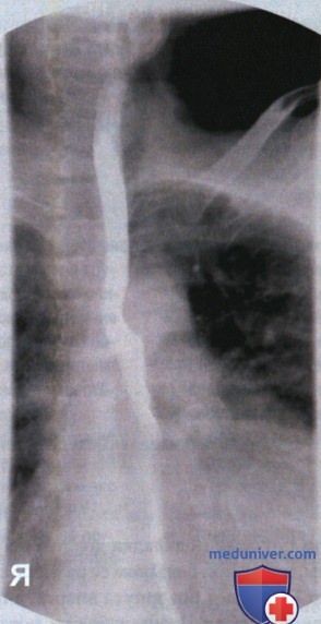 Рентгенограмма пищевода в косой ЗП проекции