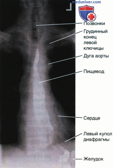 Рентгенограмма пищевода в ЗП проекции