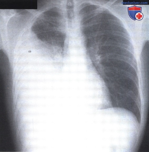 Рентгеновский снимок с затемнением правого легкого при плеврите