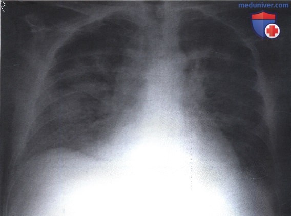 Рентгенограмма с затемнением в обоих легких при пневмоцистной пневмонии