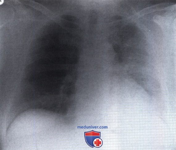 Рентгенограмма с затемнением в левом легочном поле при пневмонии
