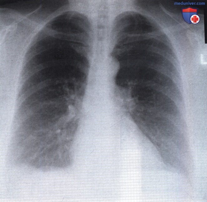 Рентгенограмма с очаговыми тенями после перенесенной ветряночной пневмонии