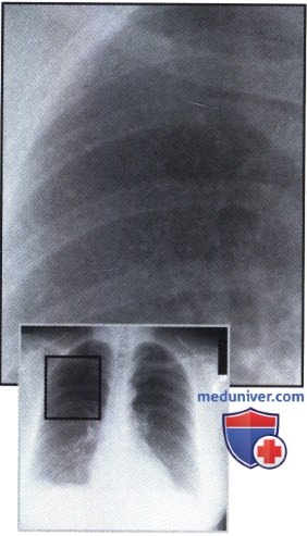 Рентгенограмма с очаговыми тенями после перенесенной ветряночной пневмонии