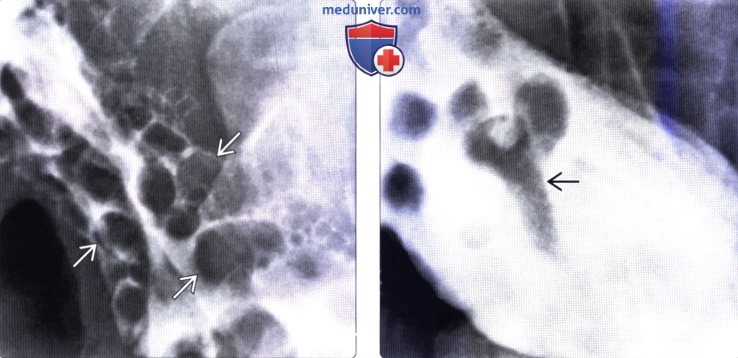 Рентгенограмма при полипе желудка