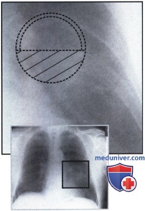 Рентгенограмма с крупной тенью, прилежащей к тени левого корня при полости