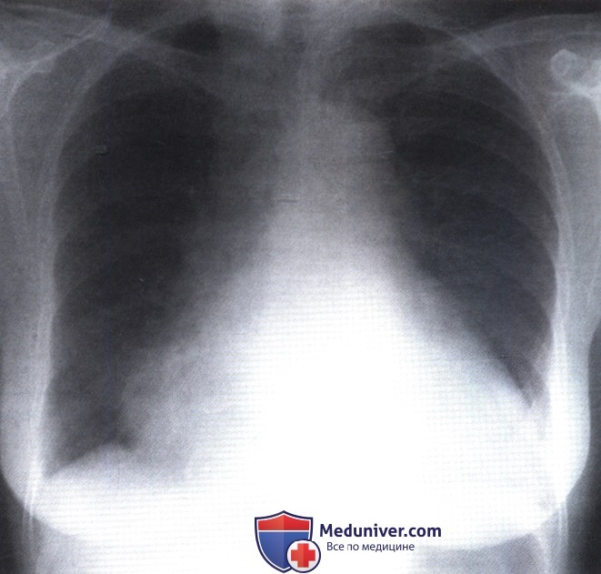 Рентгенограмма с изменением формы и увеличением сердца при пороке