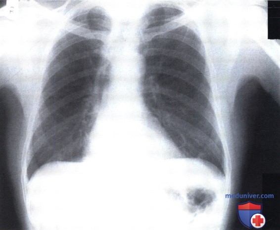 Рентгеновский снимок с патологией средостения из-за эзофагэктомии