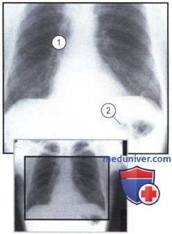 Рентгеновский снимок с патологией средостения из-за эзофагэктомии