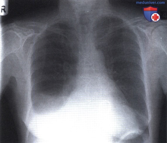 Рентгенограмма с затемнением в нижнем отделе справа после операции на сердце
