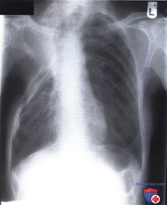 Рентгенограмма с измененной грудной клеткой после торакопластики