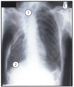 Рентгенограмма с измененной грудной клеткой после торакопластики