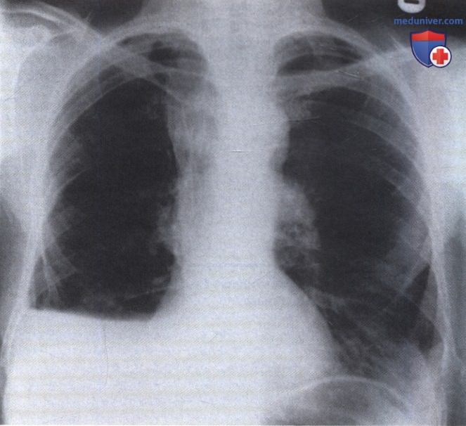 Рентгенограмма с затемнением линейной формы в базальном отделе правого легочного поля после торакотомии