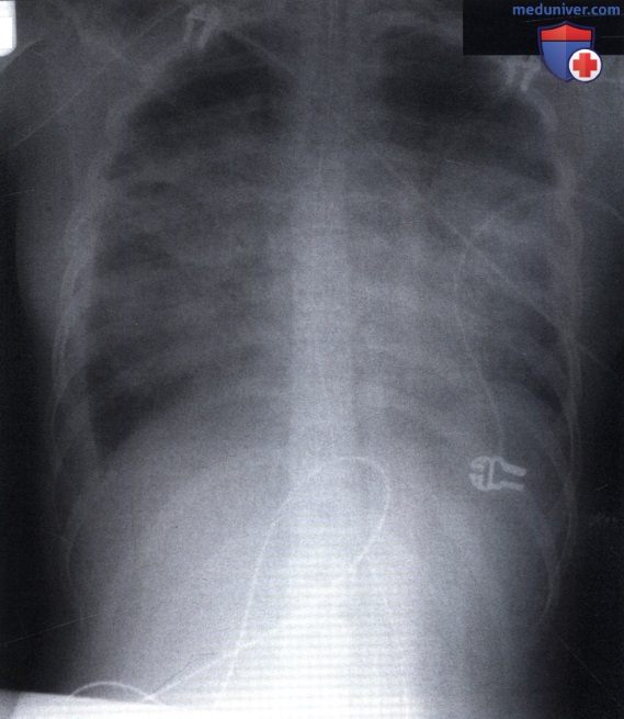 Рентгеновский снимок с затемнением обоих легочных полей после химиотерапии