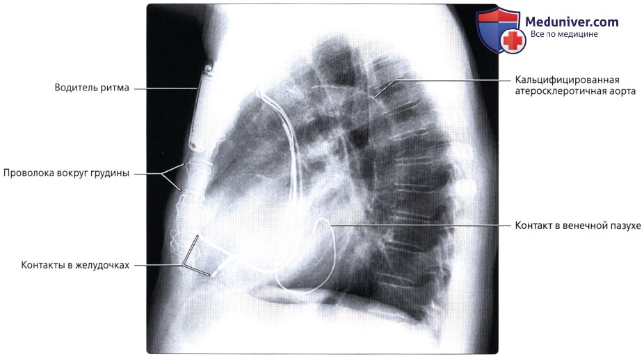 Рентгенографические плотности органов грудной клетки
