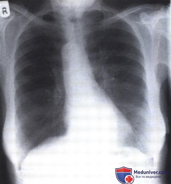 Рентгенограмма с патологией средостения при правосторонней дуге аорты