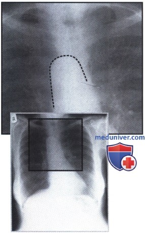 Рентгенограмма с патологией средостения при правосторонней дуге аорты