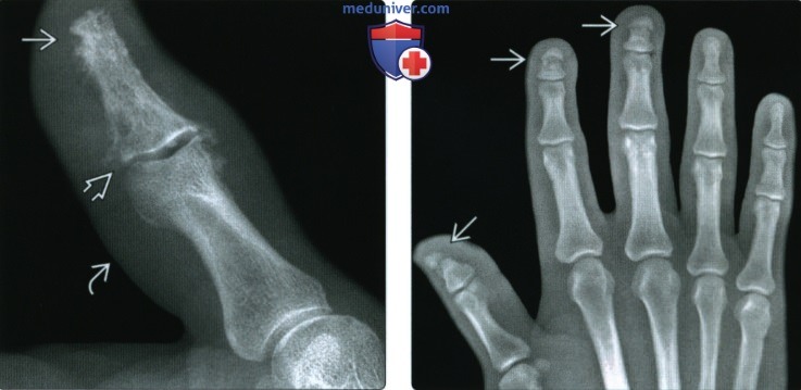 Рентгенограмма при акроостеолизе