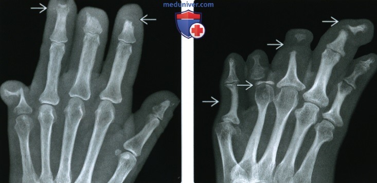 Рентгенограмма при акроостеолизе