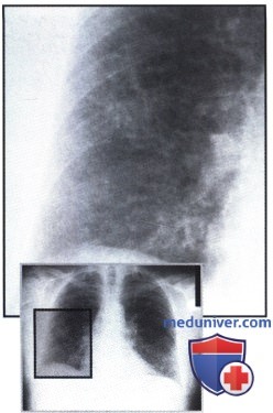 Рентгенограмма с затемнением в обоих легочных полях при фиброзе