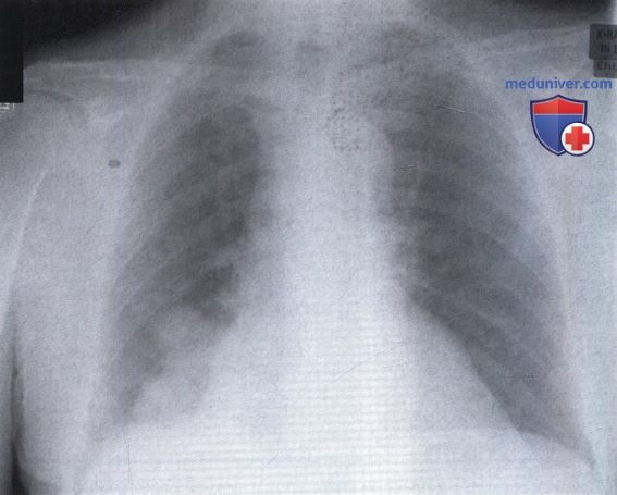 Рентгенограмма с обширным затемнением в нижнем отделе правого легочного поля при опухоли