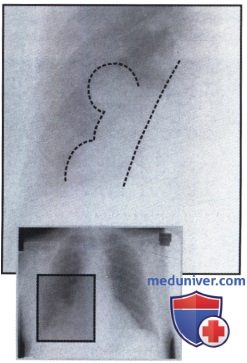 Рентгенограмма с обширным затемнением в нижнем отделе правого легочного поля при опухоли