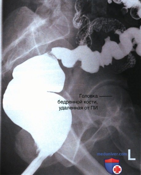 Рентгенограмма прямой кишки (толстой кишки) в боковой проекции