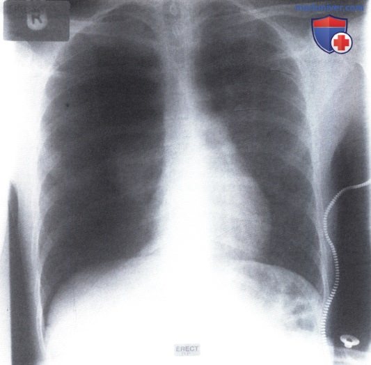 Рентгеновский снимок с просветлением правого легочного поля при пневмотораксе
