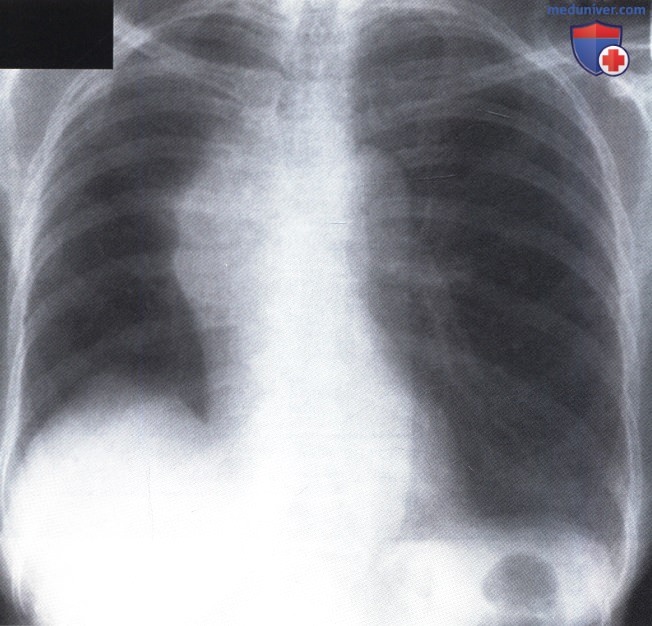 Рентгенограмма с увеличенным деформированным корнем правого легкого при раке
