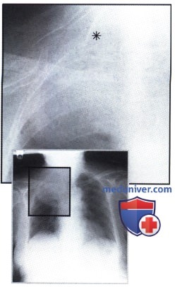 Рентгенограмма с затемнением верхнего отдела правого легкого при раке Панкоста