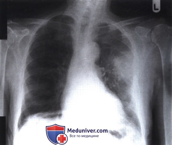Рентгенограмма с затемнением в левом легком при раке с деструкцией ребер