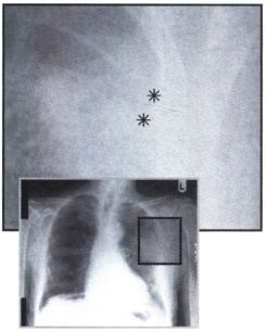 Рентгенограмма с затемнением в левом легком при раке с деструкцией ребер