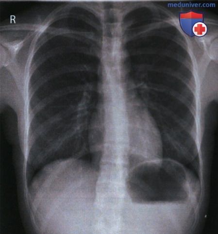 Рентгенограммы ребер в передне-задней (ПЗ) или задне-передней (ЗП) проекции