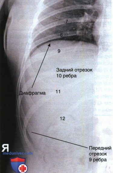 Рентгенограммы ребер в передне-задней (ПЗ) или задне-передней (ЗП) проекции