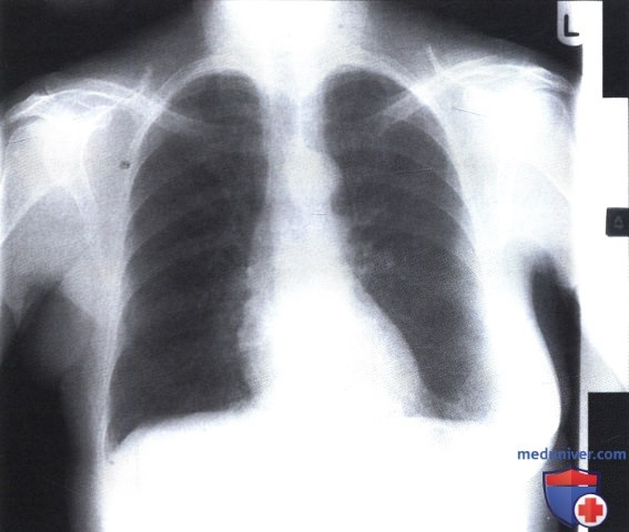 Рентгеновский снимок с нормальной грудной клеткой после мастэктомии
