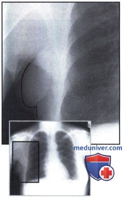 Рентгеновский снимок с нормальной грудной клеткой после мастэктомии