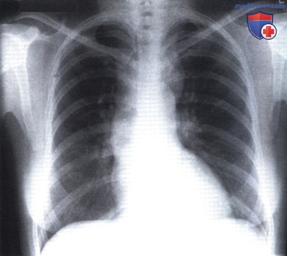 Рентгенограмма с образованием узур на ребрах при коарктации аорты