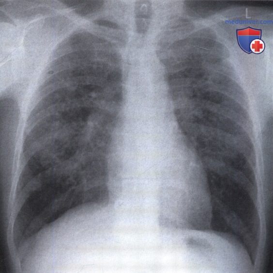 Рентгенограмма с затемнением в обоих легочных полях при саркоидозе