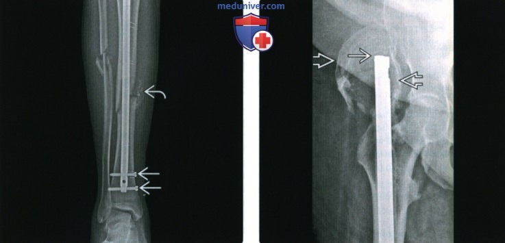 Рентгенограмма интрамедуллярного штифта (стержня)
