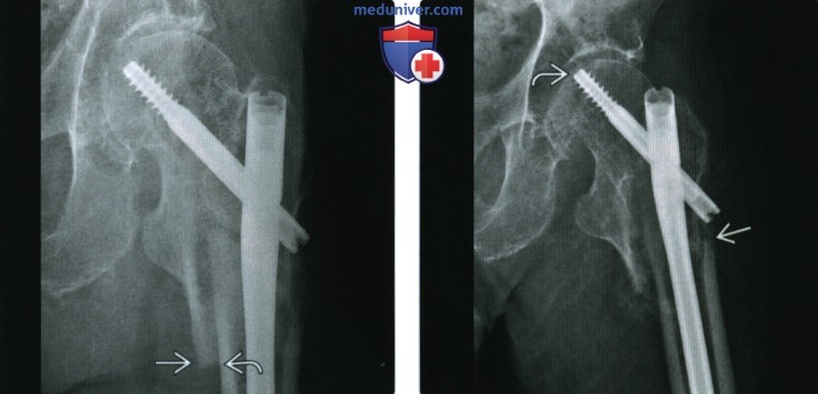 Рентгенограмма интрамедуллярного штифта (стержня)