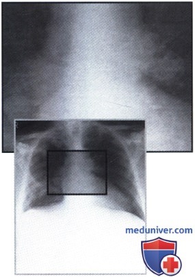 Рентгенограмма с патологически измененными и увеличенными корнями легких при силикозе