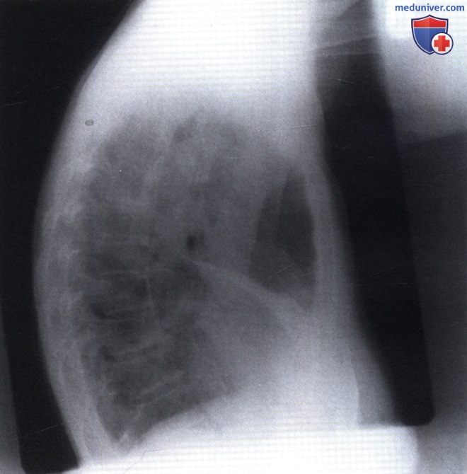 Рентгенограмма с участком затемнения при ателектазе средней доли правого легкого