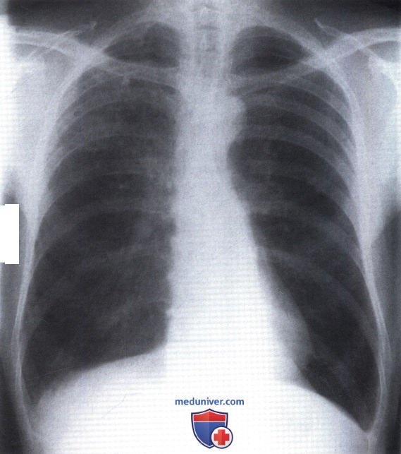 Рентгенограмма с затемнением в верхней доле правого легкого при старом туберкулезе