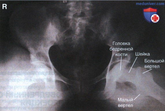 Рентгенограмма таза в ПЗ проекции в позе лягушки (модифицированный метод Кливза)