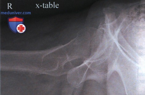Рентгенограмма тазобедренного сустава в аксиолатеральной проекции (нижневерхней, по методу Данелиуса-Миллера)