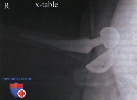 Рентгенограмма тазобедренного сустава в аксиолатеральной проекции (нижневерхней, по методу Данелиуса-Миллера)