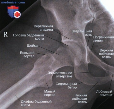 Укладка при рентгенограмме тазобедренного сустава в ПЗ проекции в позе лягушки (модифицированный метод Кливза)