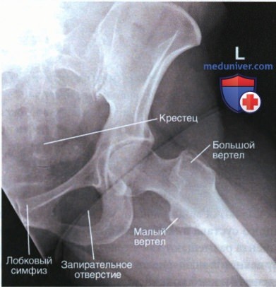 Рентгенограмма тазобедренного сустава в ПЗ проекции в позе лягушки (модифицированный метод Кливза)
