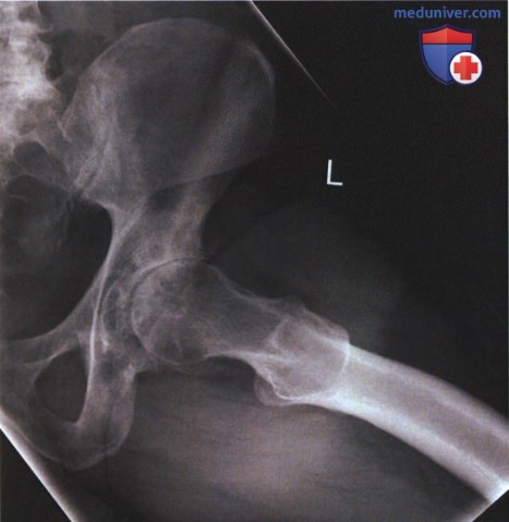 Рентгенограмма тазобедренного сустава в ПЗ проекции в позе лягушки (модифицированный метод Кливза)
