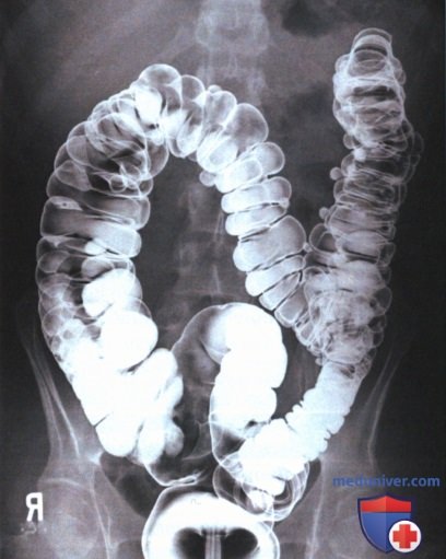 Рентгенограмма толстой кишки в правой передней косой проекции